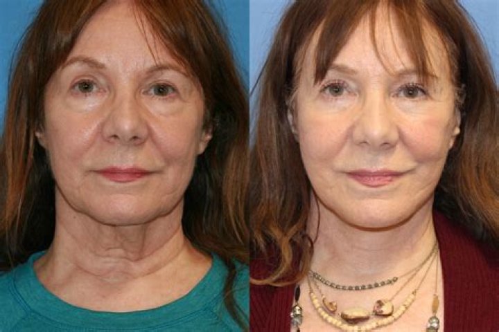 Before And After Photos And Surgery Details