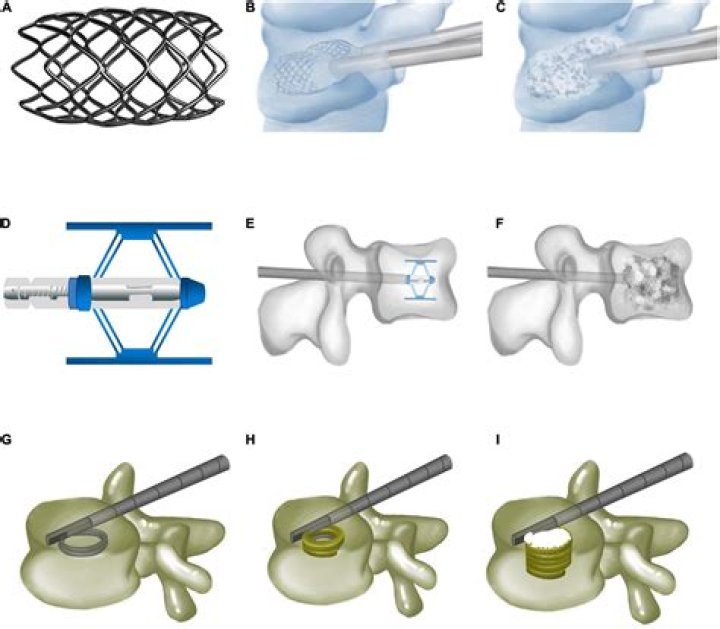 Essential Guide To T12 Vertebral Fracture Treatment