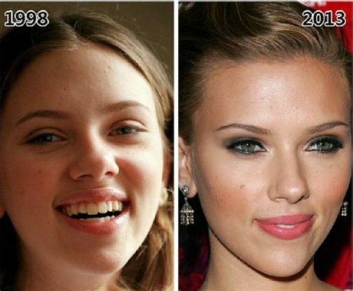 Scarlett Johansson's Plastic Surgery: Uncovering The Truth