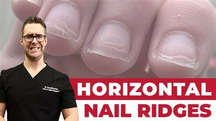 The Revealing Ridges On Fingernails
