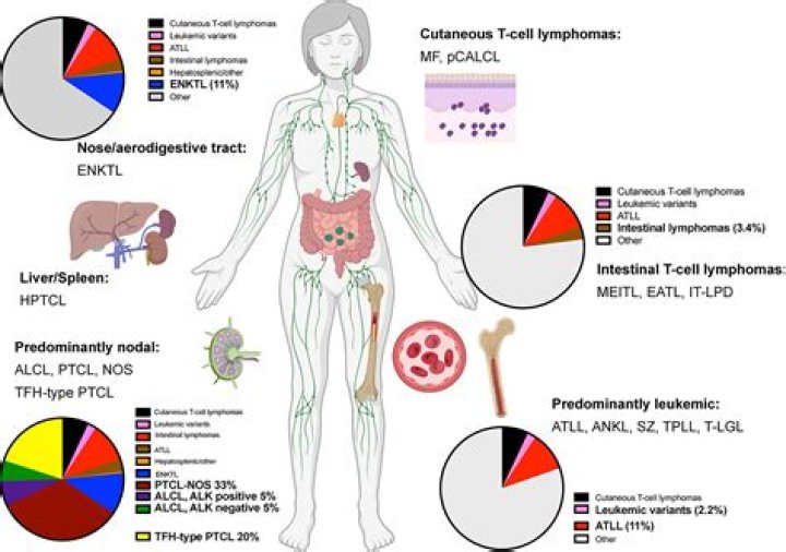 Understanding The Devastating Impact: Death From Lymphoma